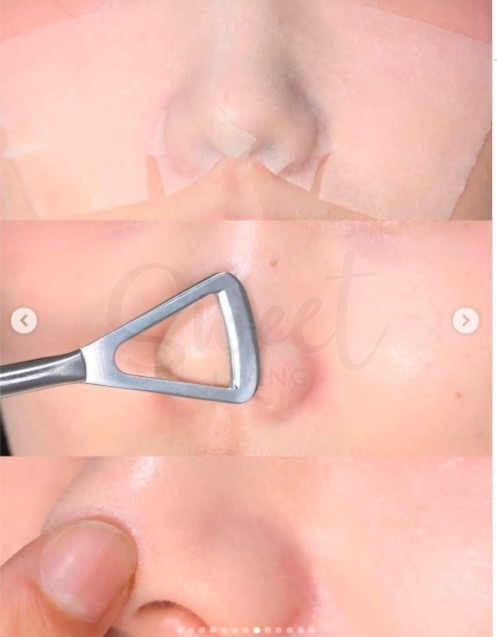 【韩国】Beplain 绿豆黑头导出液套组  150ml + 化妆棉片 40pcs + 双头黑头铲 / Beplain mung bean pore scaling water set -  - 5@ - Sweet Living